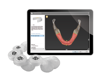 四街道駅・OSHIMA DENTAL OFFICE(オオシマデンタルオフィス)・手術用ガイドの作成