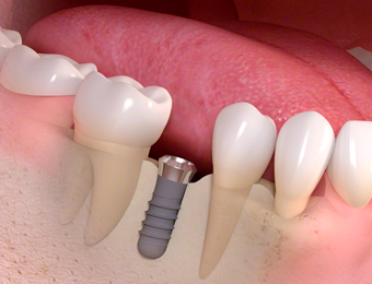 四街道駅・OSHIMA DENTAL OFFICE(オオシマデンタルオフィス)・インプラント体の埋入