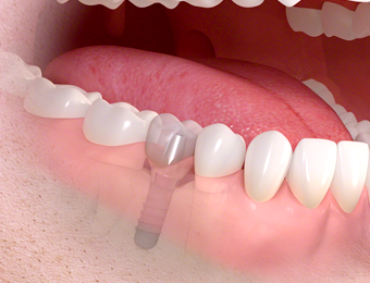 四街道駅・OSHIMA DENTAL OFFICE(オオシマデンタルオフィス)・歯の型取り、仮歯の装着